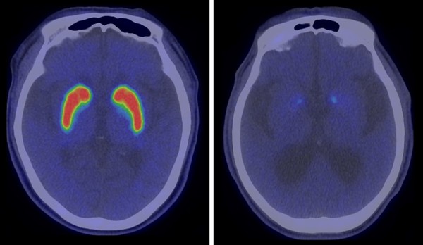 사진. 정상 뇌(좌)와 파킨슨병 환자의 뇌(우) PET 비교