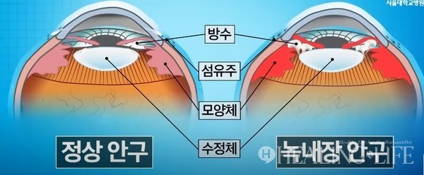 ▲ 정상 안구와 녹내장 안구의 비교 @서울대학교병원